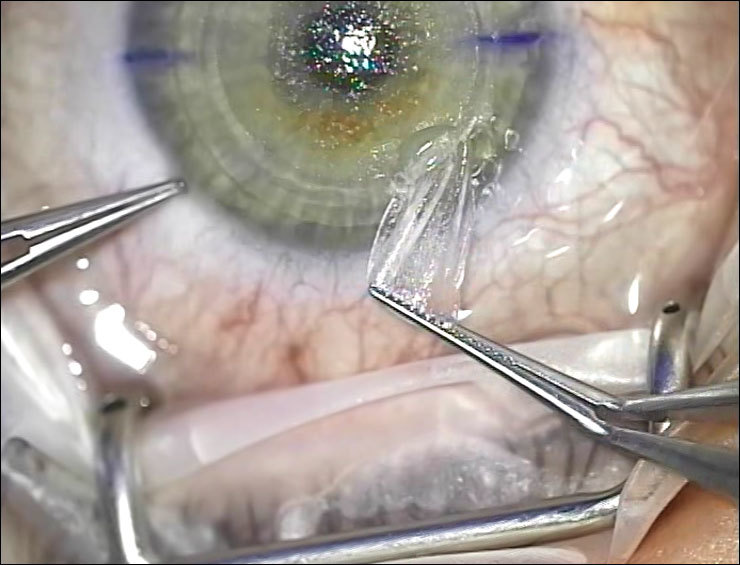 коррекция сетчатки