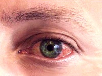 диагностика покраснения глаза