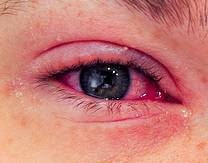 Adenoviral-infection