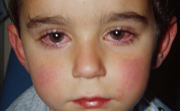 болезни глазок у детей