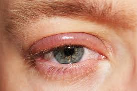 симптомы блефарита