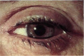 клещ демодекс