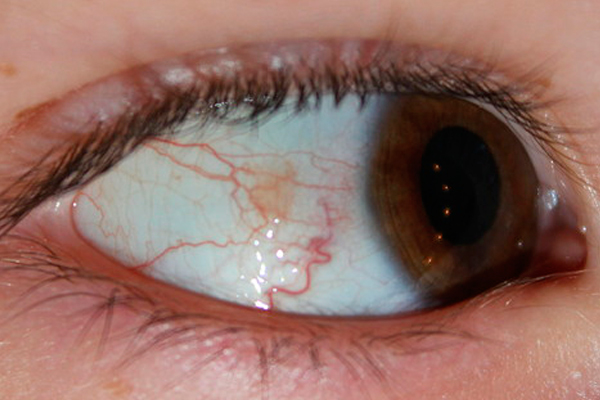 вид эписклерита