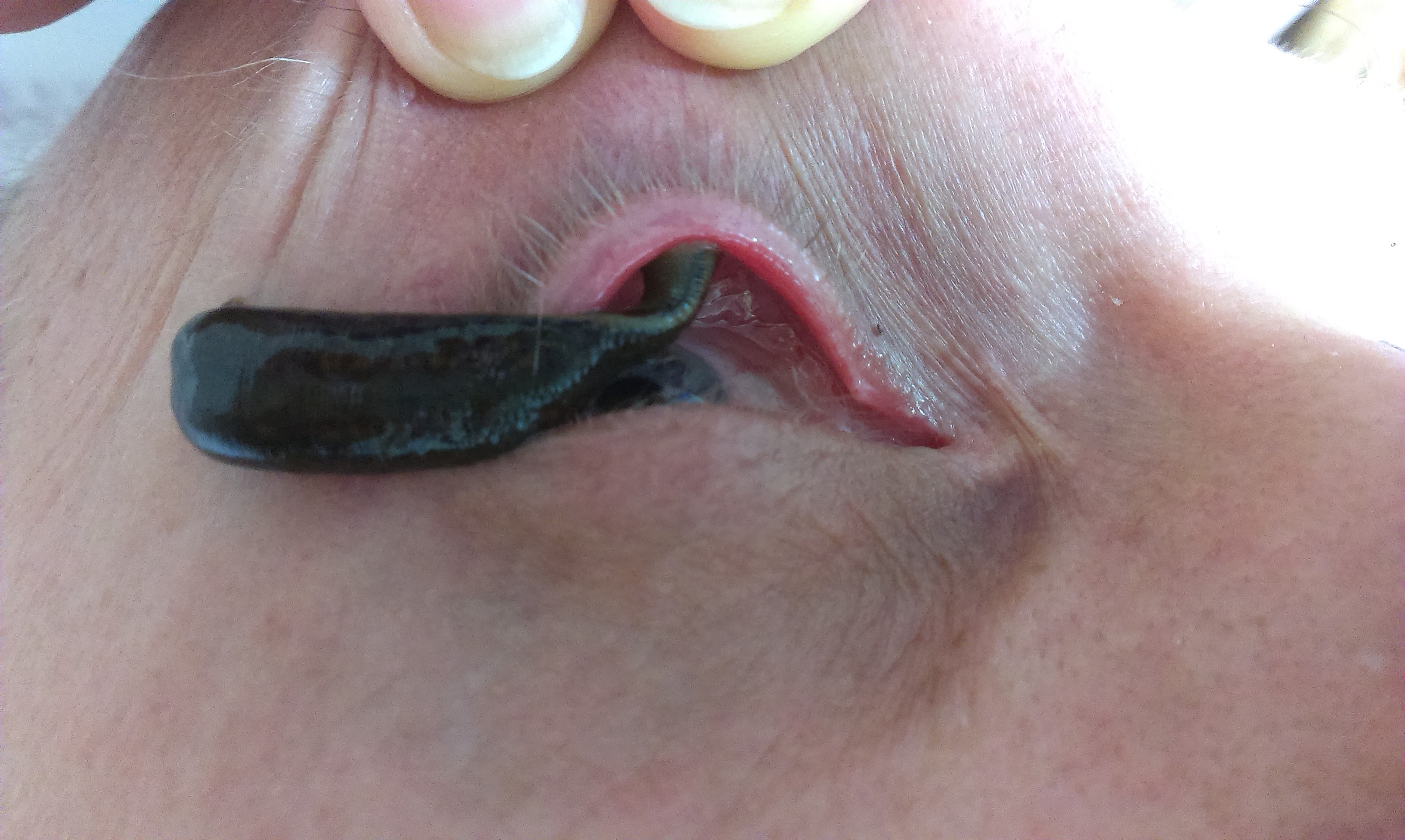 пиявки в глазах