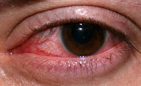 пораженный глаз