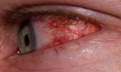 конъюнктивит