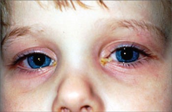 Конъюнктивит