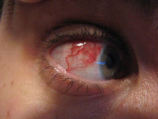 лечение сосудов глаз