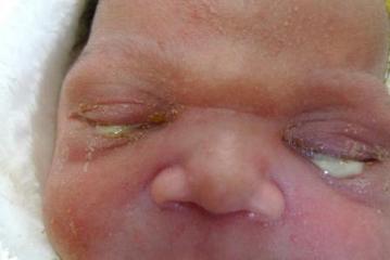 как выглядит дакриоцистит у детей