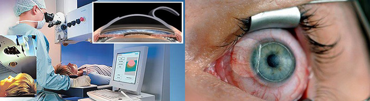 операция ласик