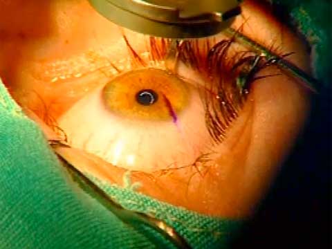 хирургическое лечение близорукости