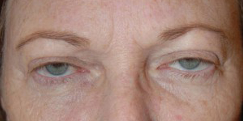 фото птоза у женщин