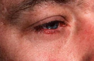 демодекоз век