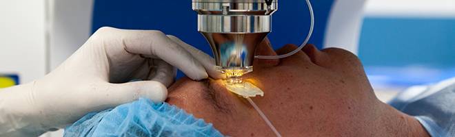 избавление от мушек с помощью лазера