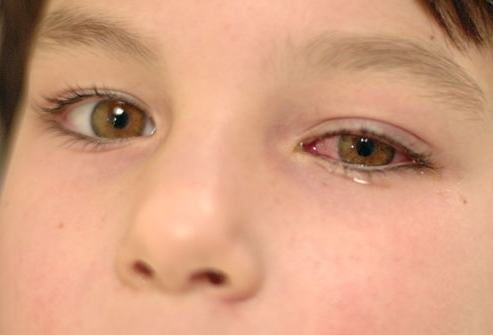 adenovirusnyj-konyunktivit-u-detej