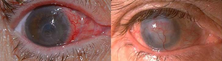 вид кератита