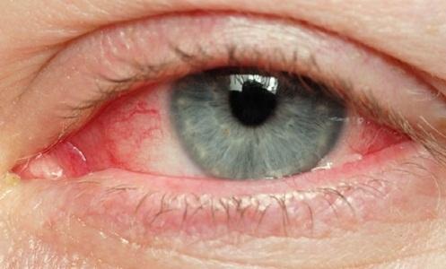 симптомы аллергии глаз