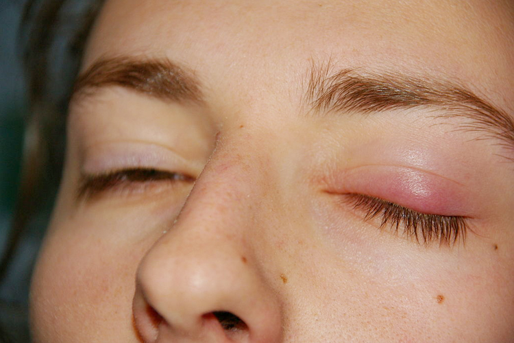 глазной ячмень