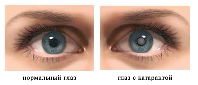 вид катаракты