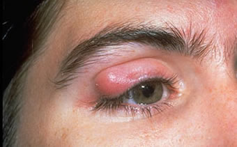 верхнее веко воспаление