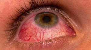 симптом кератита