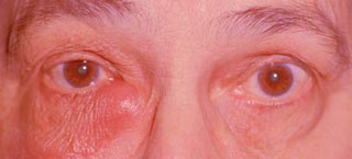 дакриоцистит у взрослого