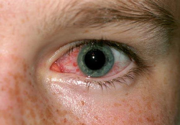 симптомы демодекоза