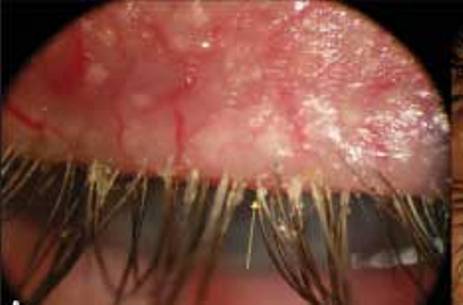 демодекоз глаз