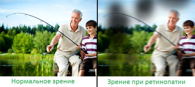 глазная ретинопатия