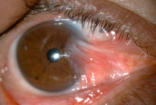 симптомы птеригиума глаза