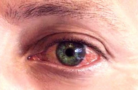 симптом герпеса на глазу