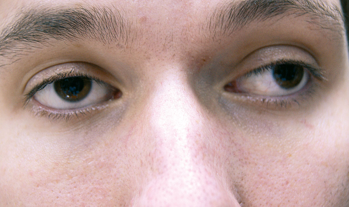 астигматизм ребенка