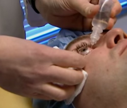 лазерное удаление астигматизма