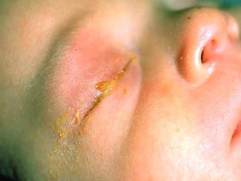 gnojnyj-konyunktivit