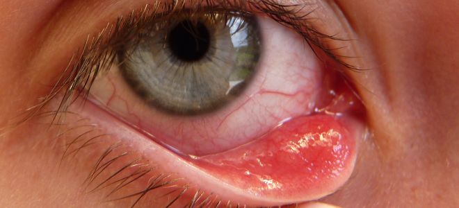 внешний вид грибкового кератита