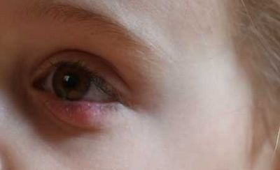 воспаление у детей