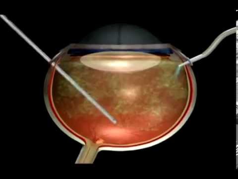 лазерная коррекция