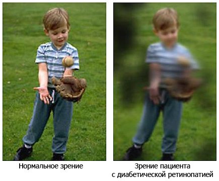 ретинопатия