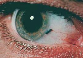 симптомы травмы глаза