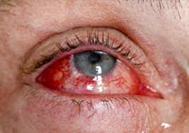 покраснение