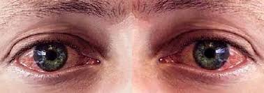 причины красных глаз