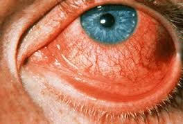 аллергический конъюнктивит