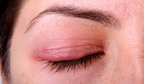 симптомы блефарита