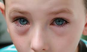 симптомы красных глаз