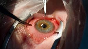 операция на глаза