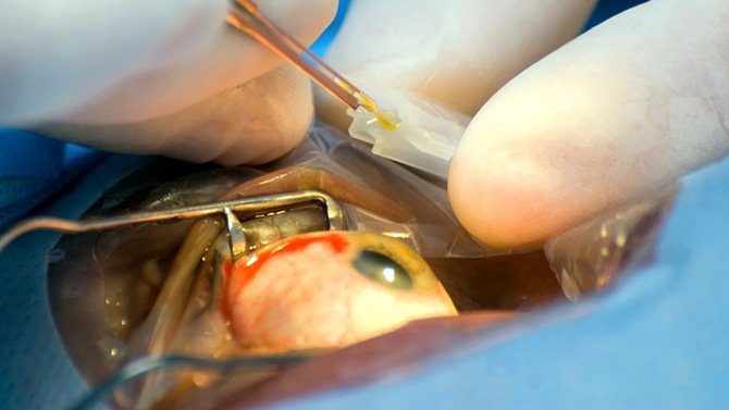 удаление косоглазия