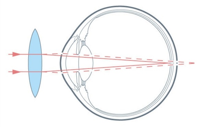 изменение эмметропии