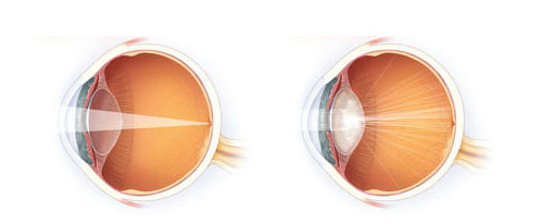 после лазера