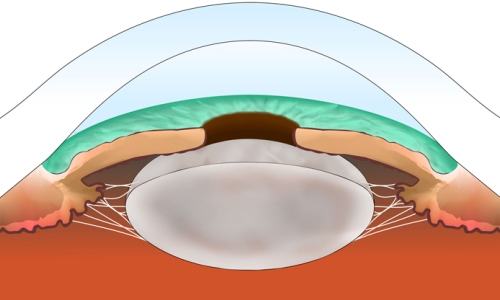 удаление катаракты