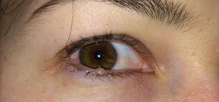 симптомы кисты